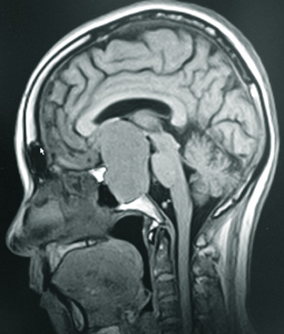 МРТ головного мозга с акцентом на гипофиз